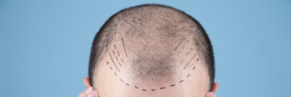 What are the different types of hair transplant?