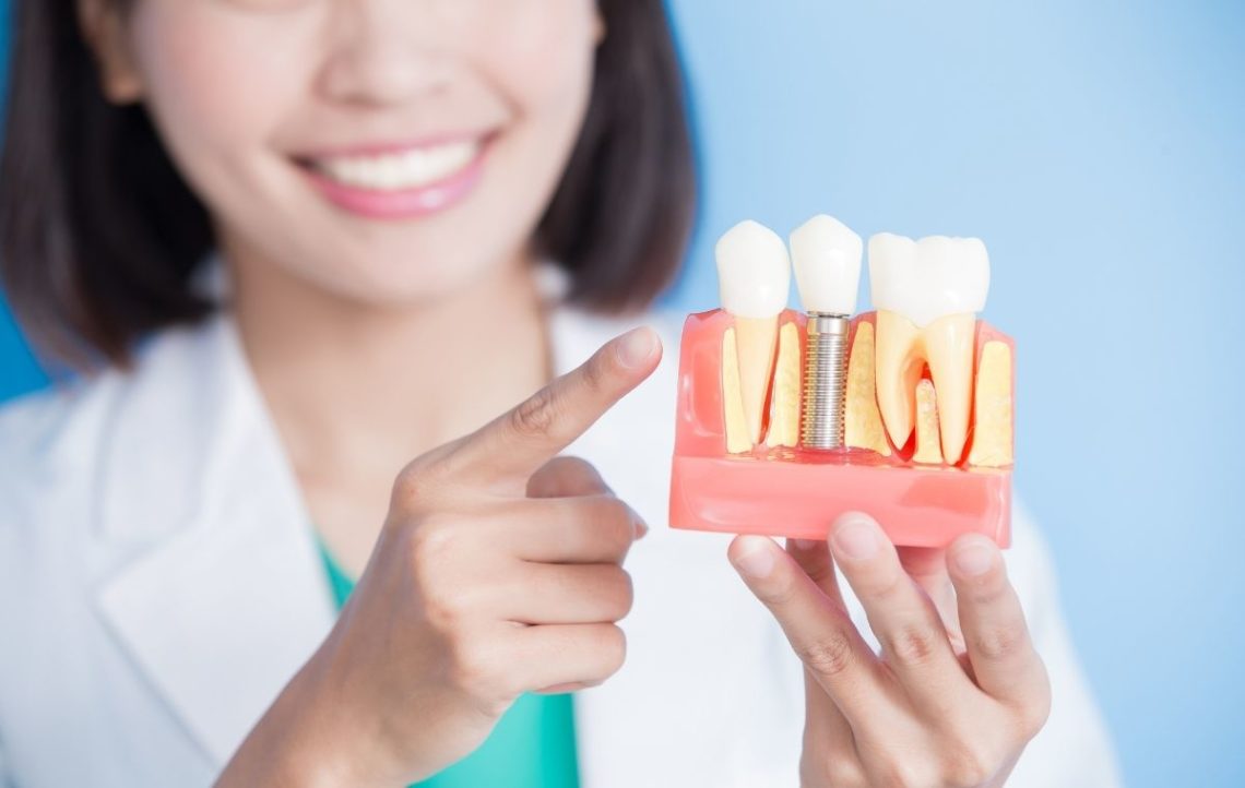 How Long Do Dental Implants Last?