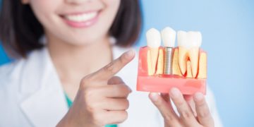 How Long Do Dental Implants Last?