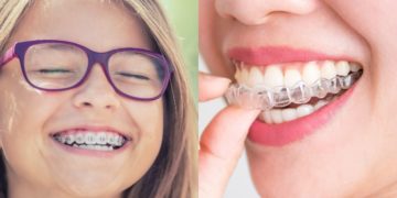 Invisalign vs. Braces Pros, Cons, Faster Results
