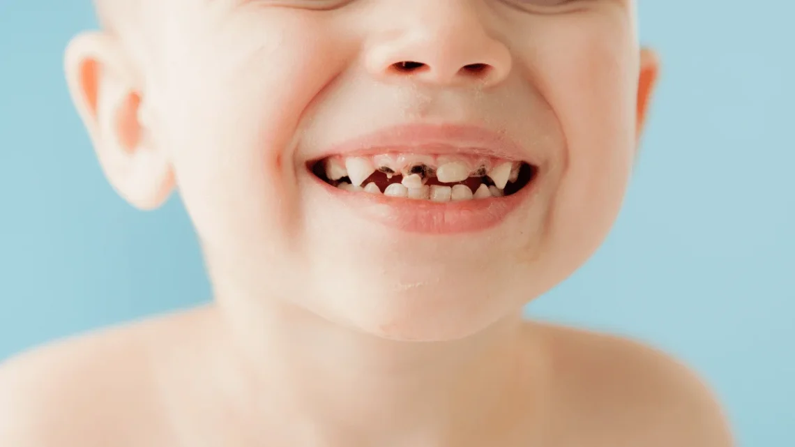 Baby Bottle Tooth Decay Early Signs and Treatment Options