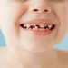 Baby Bottle Tooth Decay Early Signs and Treatment Options