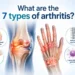 What are the 7 types of arthritis
